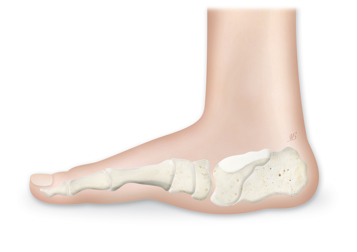 Posttraumatic Reconstruction of the Ankle Using the Ilizarov