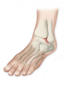 Rheumatoid arthritis of the ankle