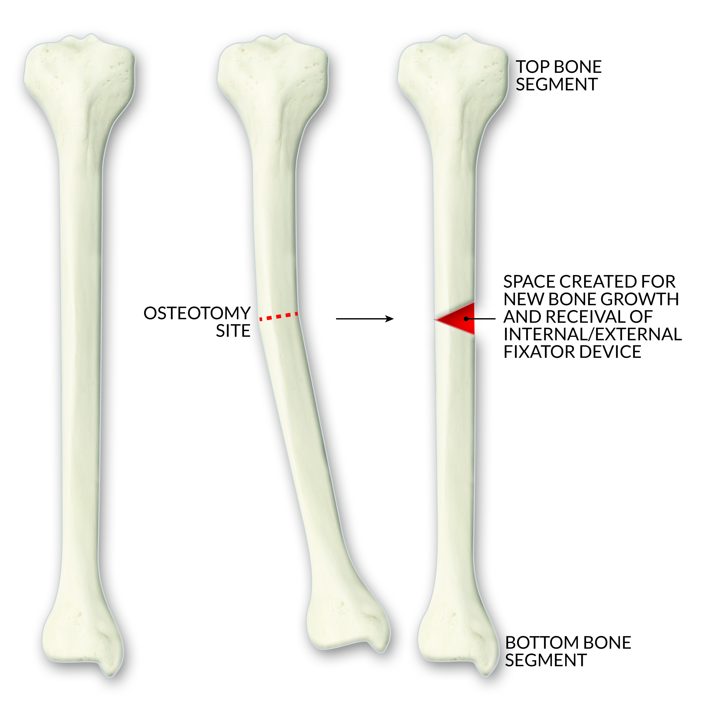 Limb deformity correction