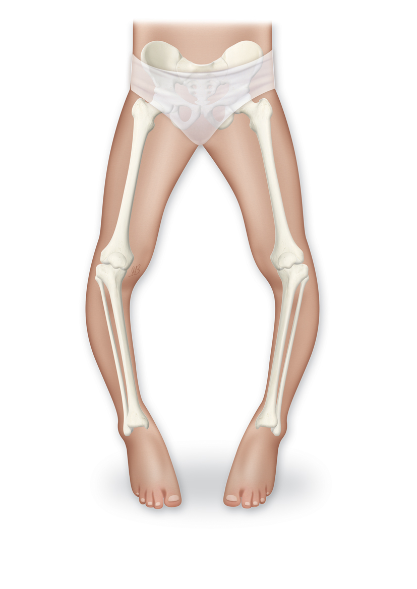 Blount’s Disease Bilateral